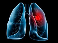 113477174  Lung cancer